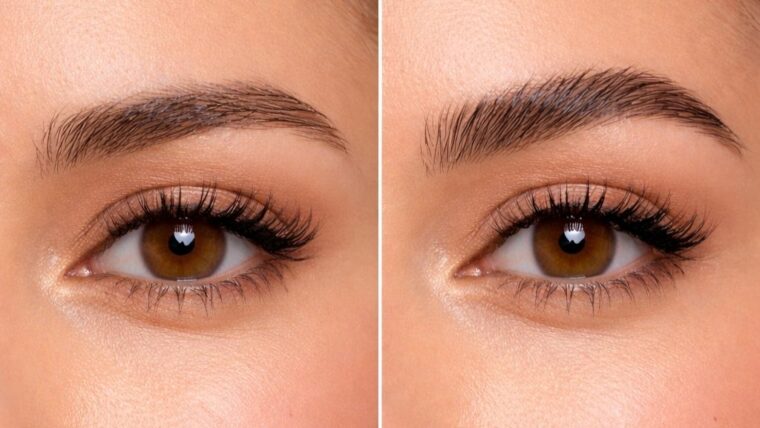 למינציה לגבות: איך עובד הטיפול ומה אומר המחקר המדעי